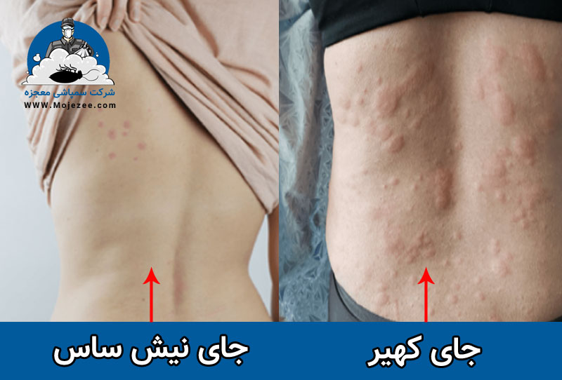 تفاوت کهیر و جای نیش ساس 