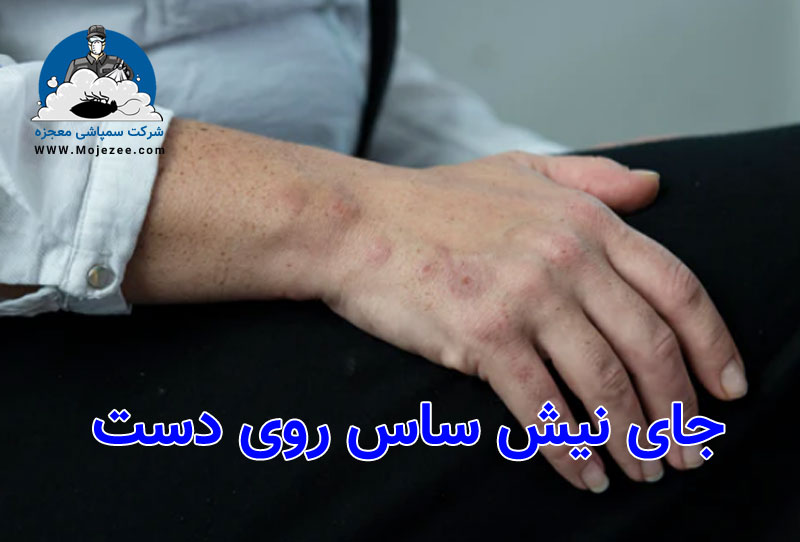 جای نیش ساس روی دست 