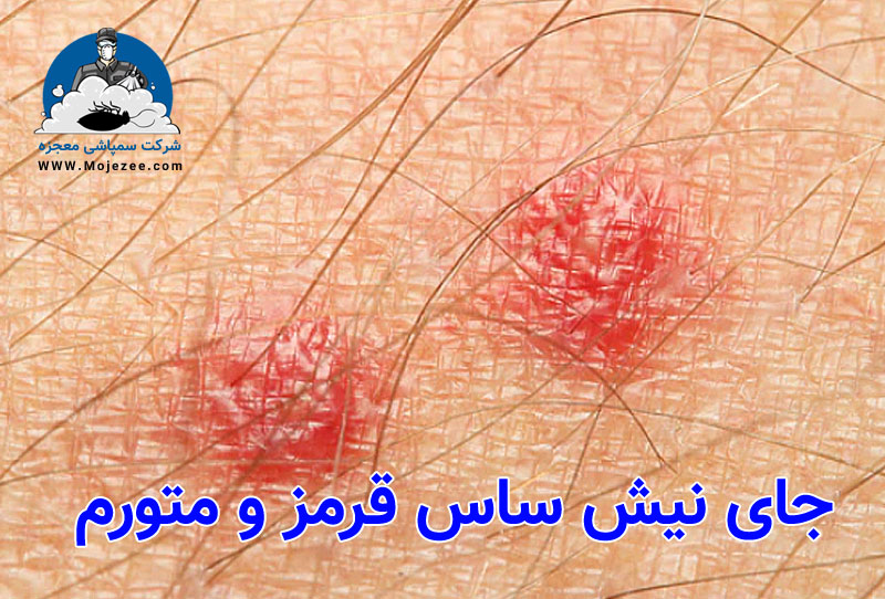 جای نیش ساس قرمز و متورم mojezee.com
