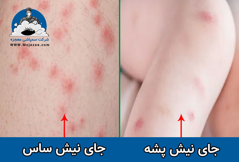 جای نیش پشه و نیش ساس