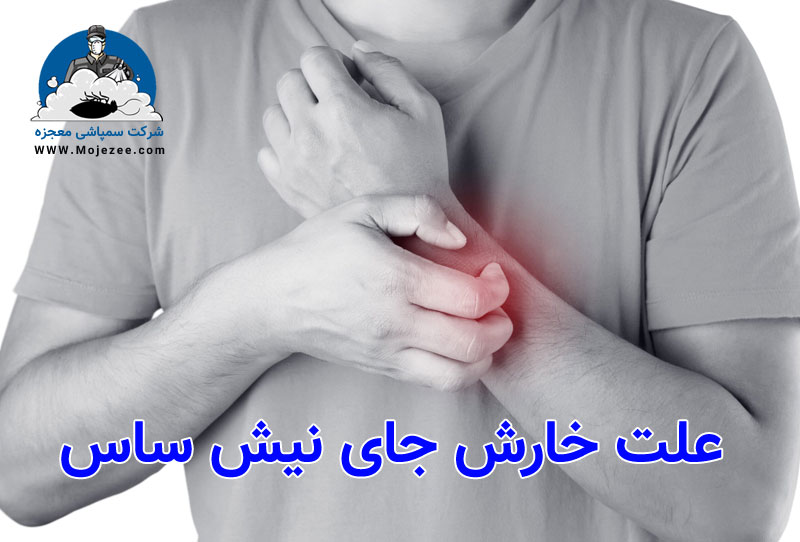 علت خارش جای نیش ساس 